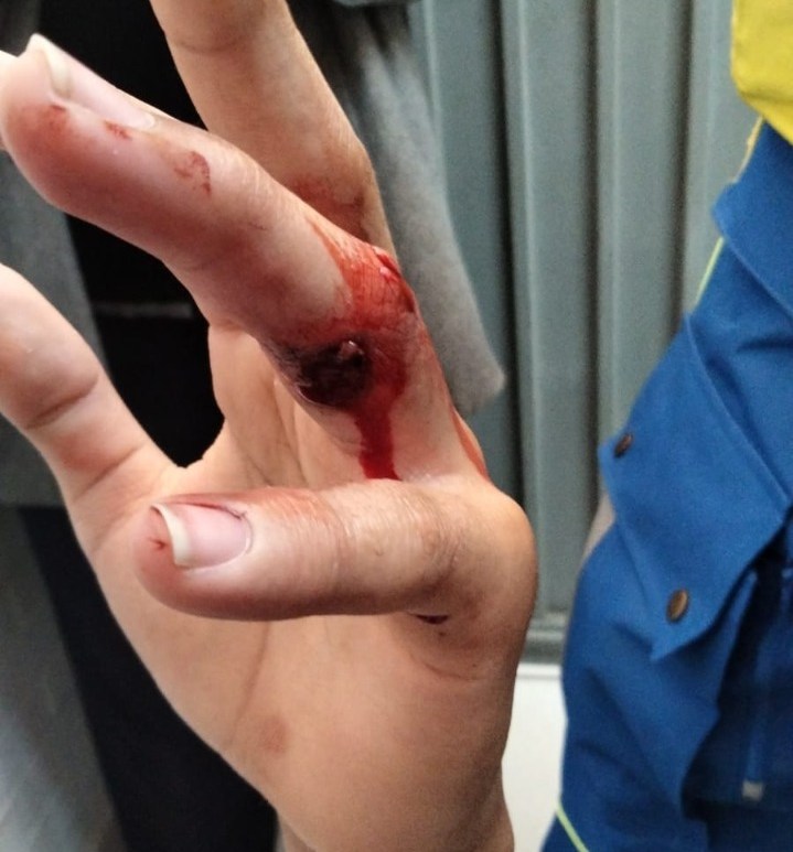 Ojiva de arma de fuego alojada en dedo de estudiante