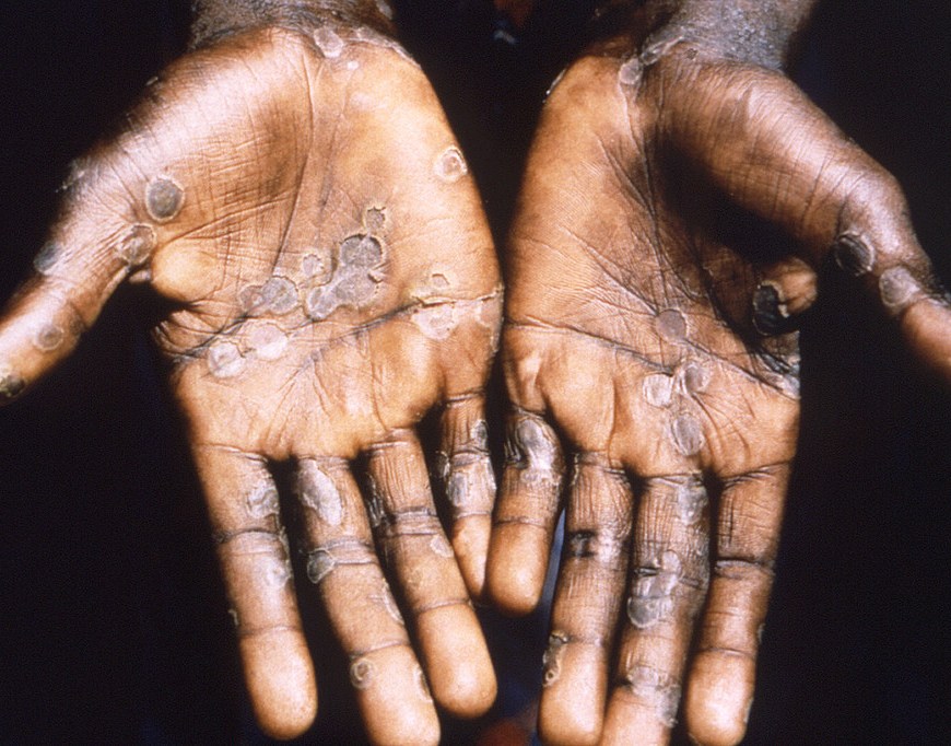 Las lesiones por viruela del mono suelen aparecer en las palmas de las manos.