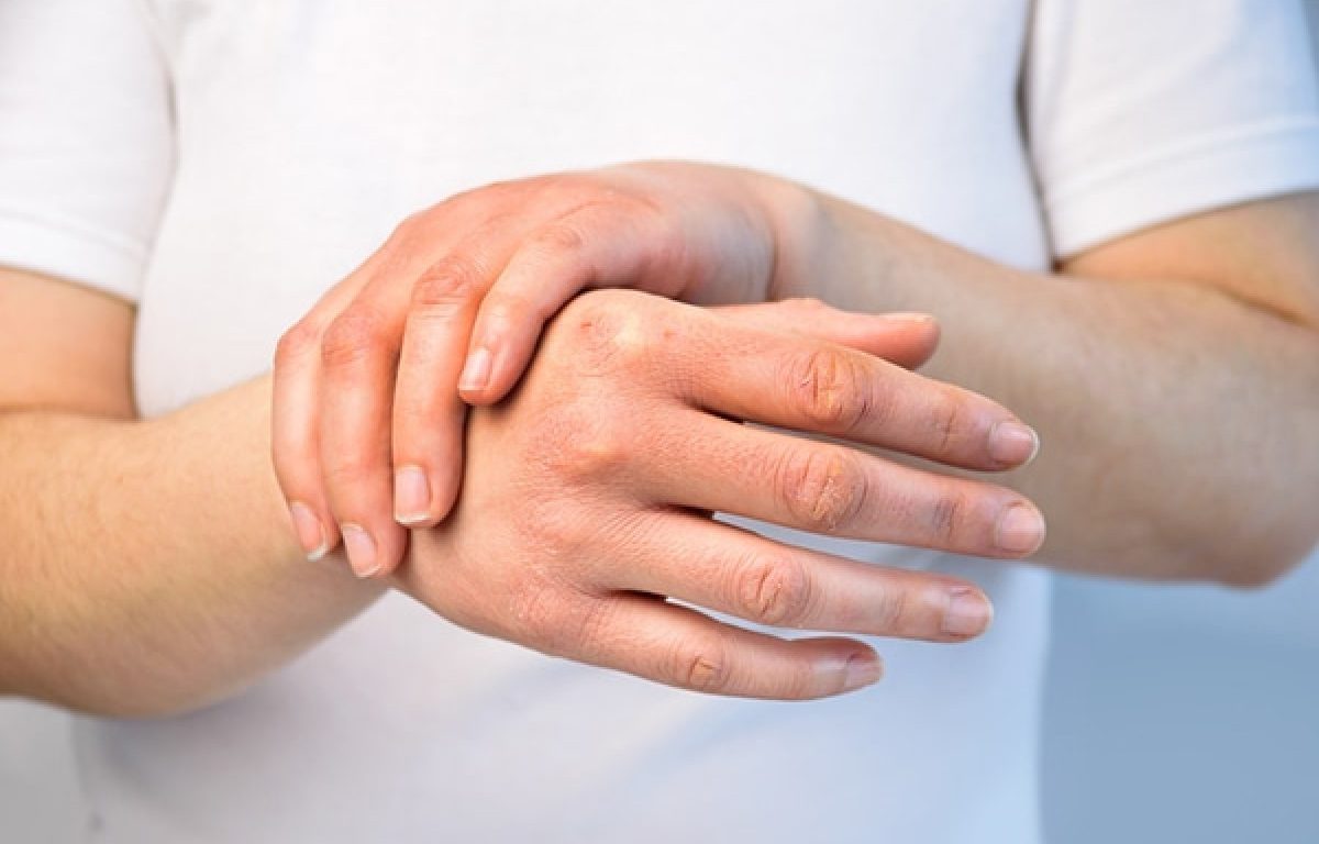 Esclerodermia