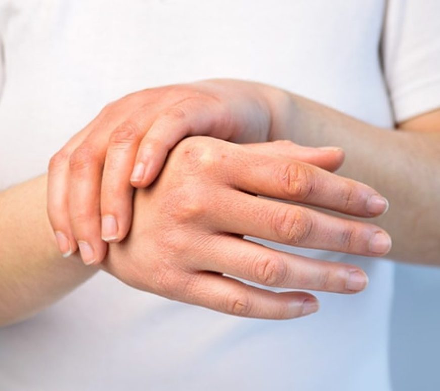 Esclerodermia