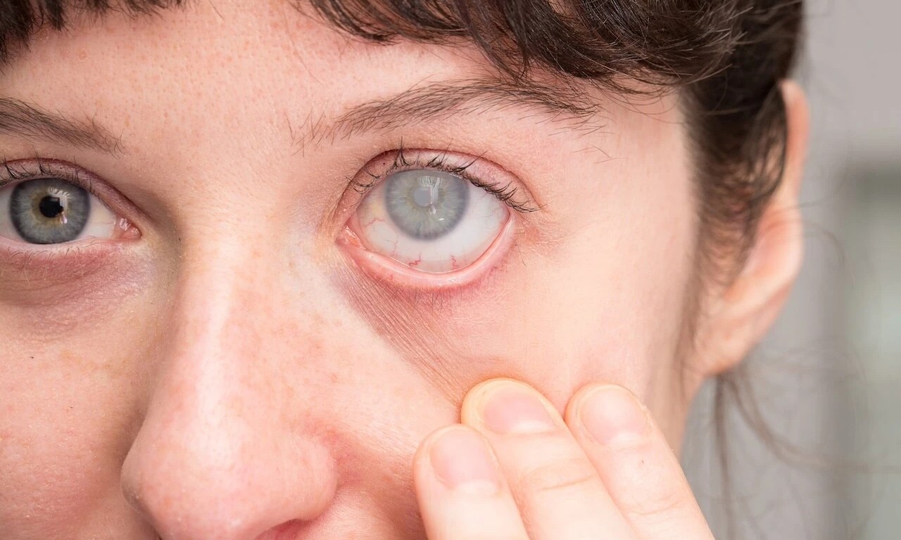 Cataratas en ojos